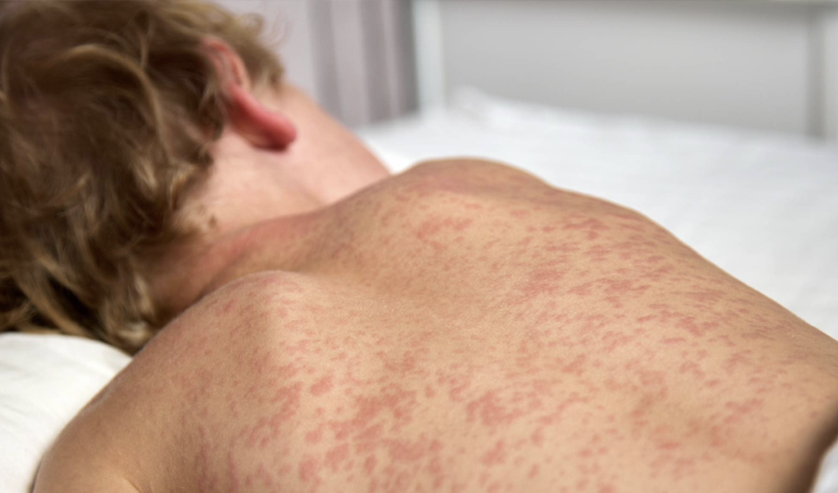 Canada Loses Measles-Free Status as Outbreaks Spread Across the Americas